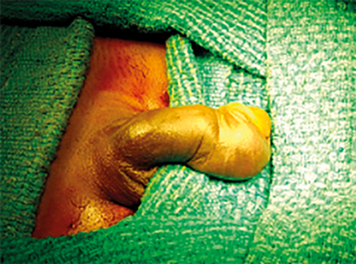 Penile Fracture Urology News