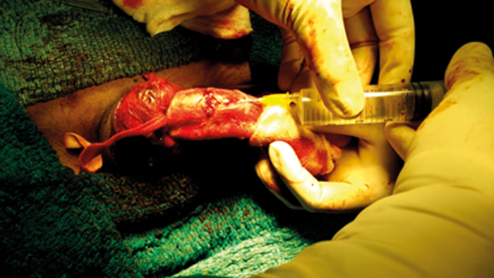 Penile Fracture Urology News