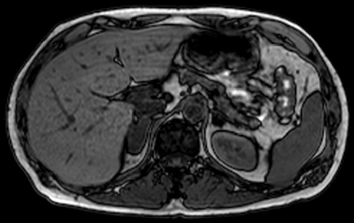 Assessment of the incidental adrenal lesion | Urology News