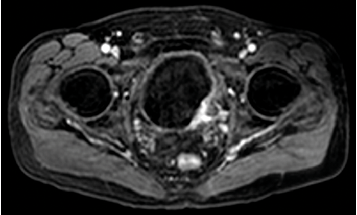 Bladder carcinoma MRI - Medicine - www.MedicalTalk.Net the Best Medical ...