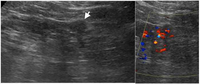 Indeterminate renal lesions – a pragmatic imaging approach | Urology News