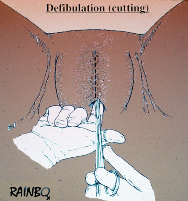 The impact of FGM on the genitourinary system a 2021 perspective