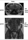MRI scan in axial and coronal planes showing bilateral hydronephrosis in pregnancy.