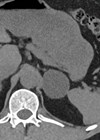 Axial non contrast CT. The left adrenal gland shows a well circumscribed uniform low attenuation mass.