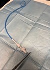 Photos showing long pigtail thread sitting outside of the drainage system which has been shortened and correctly inserted into the drainage tube under aseptic technique.