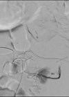 Image showing embolisation of the inferior segmental artery of the left kidney.
