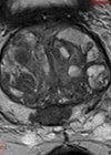 Prostate cancer MRI image.