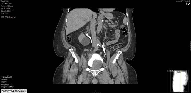 Figure 1: CT Urogram