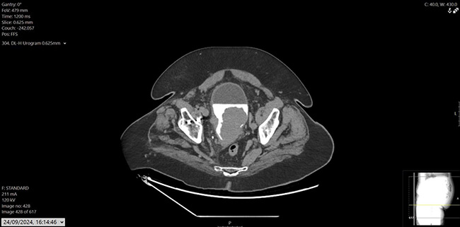 Figure 2: CT urogram, axial.