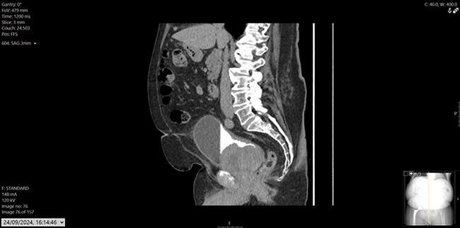 Figure 3: CT urogram, sagittal.