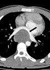 Scan showing 7 x 5 x 7cm low attenuation mediastinal mass compressing the left atrium.