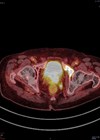 Prostate cancer management scan image.