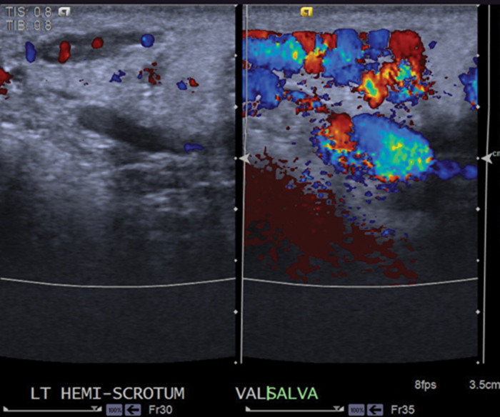 Imaging Of Varicoceles Urology News