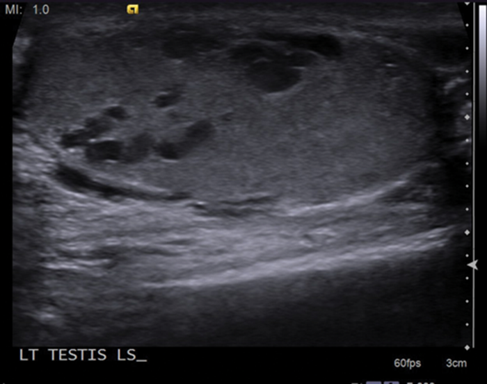 Varicocele Ultrasound Video