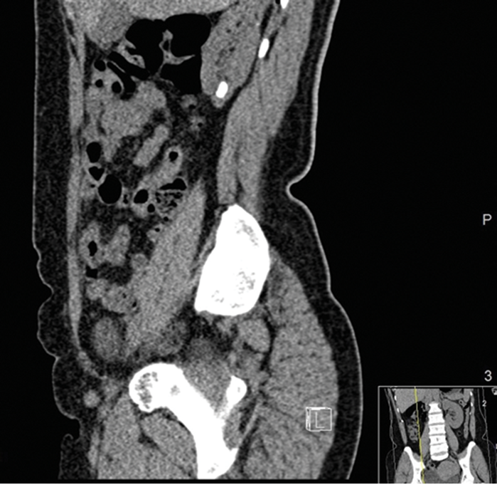 management-of-calyceal-diverticular-stones-using-ultramini-pcnl