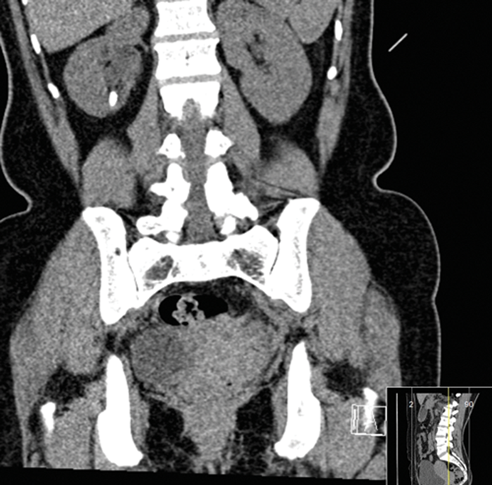 Management of calyceal diverticular stones using ultramini PCNL ...