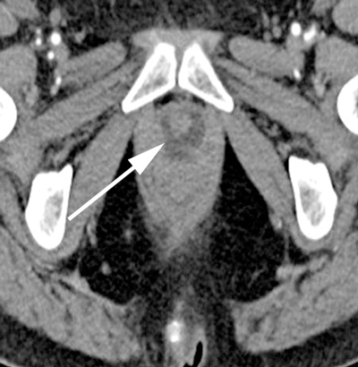 Urethral Diverticulum: A Review Of The Literature And Local Experience ...