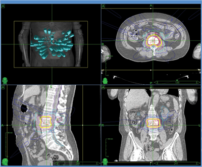 Stereotactic Body Radiotherapy For Oligometastatic Disease Secondary To ...